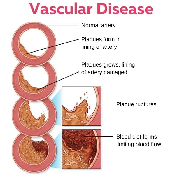 Vasculife™ Vascular Care ION-Bangle