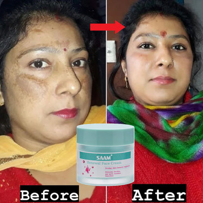 Saam™ Renewal Face Cream, Remove Wrinkles, Melasma, Freckles, Skin Aging, Dark skin