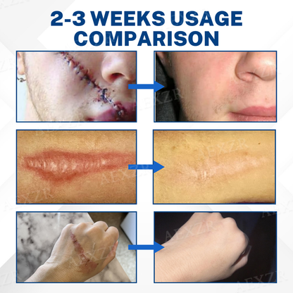 ScarPhix™ Scar Removal Cream