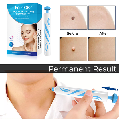 Fivfivgo™ At-home Skin Tag Removal Pen