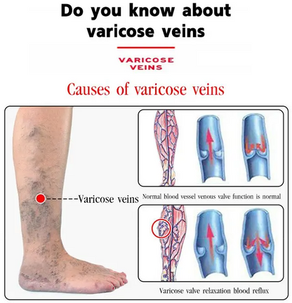 Varicose Veins Treatment Cream