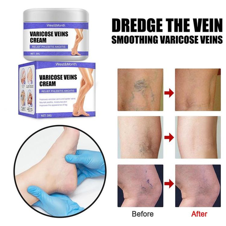 Varicose Veins Treatment Cream