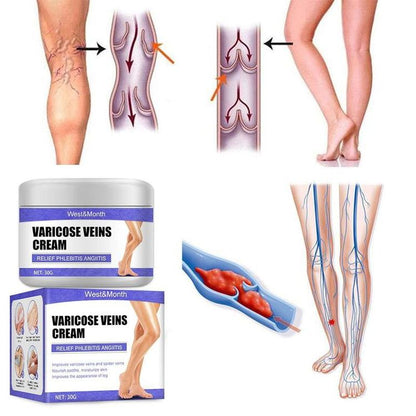 Varicose Veins Treatment Cream