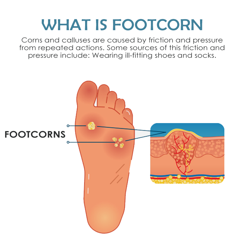 ATTDX FootCorn CallusesRemoval Plaster