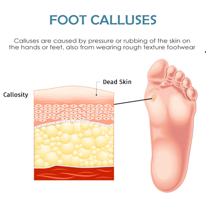 ATTDX FootCorn CallusesRemoval Plaster